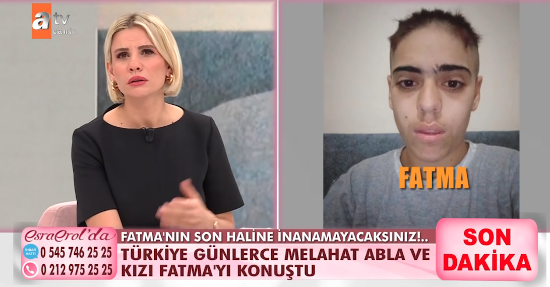 Esra Erol'da zihinsel engelli Fatma'nın son hali yürekleri dağladı! Saçlarını kazıttı